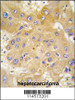 Formalin-fixed and paraffin-embedded human hepatocarcinoma tissue reacted with LAP3 antibody, which was peroxidase-conjugated to the secondary antibody, followed by DAB staining.