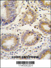 Formalin-fixed and paraffin-embedded human colon carcinoma tissue reacted with LEFTB antibody, which was peroxidase-conjugated to the secondary antibody, followed by DAB staining.