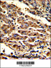 Formalin-fixed and paraffin-embedded human hepatocarcinoma with HOMER1 Antibody (N-term) , which was peroxidase-conjugated to the secondary antibody, followed by DAB staining.