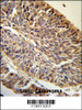 PITX1 Antibody (RB18913) IHC analysis in formalin fixed and paraffin embedded human Lung carcinoma followed by peroxidase conjugation of the secondary antibody and DAB staining.