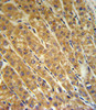CP Antibody IHC analysis in formalin fixed and paraffin embedded human hepatocarcinoma followed by peroxidase conjugation of the secondary antibody and DAB staining.