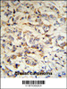 CPN2 Antibody (RB18703) IHC analysis in formalin fixed and paraffin embedded human breast carcinoma tissue followed by peroxidase conjugation of the secondary antibody and DAB staining.