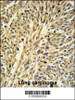 IMPDH2 Antibody IHC analysis in formalin fixed and paraffin embedded human Lung carcinoma followed by peroxidase conjugation of the secondary antibody and DAB staining.