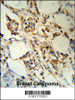 RBM3 Antibody (RB18777) IHC analysis in formalin fixed and paraffin embedded human breast carcinoma followed by peroxidase conjugation of the secondary antibody and DAB staining.