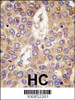 Formalin-fixed and paraffin-embedded human hepatocarcinoma tissue reacted with CK1g2 antibody, which was peroxidase-conjugated to the secondary antibody, followed by DAB staining.