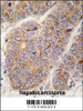 Formalin-fixed and paraffin-embedded human hepatocarcinoma tissue reacted with APOA2 antibody, which was peroxidase-conjugated to the secondary antibody, followed by DAB staining.