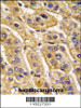 Formalin-fixed and paraffin-embedded human hepatocarcinoma tissue reacted with HIBCH antibody, which was peroxidase-conjugated to the secondary antibody, followed by DAB staining.