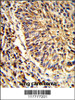 Formalin-fixed and paraffin-embedded human lung carcinoma reacted with ADAM9 Antibody, which was peroxidase-conjugated to the secondary antibody, followed by DAB staining.