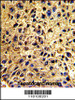Formalin-fixed and paraffin-embedded human hepatocarcinoma with, which was peroxidase-conjugated to the secondary antibody, followed by DAB staining.