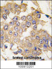 Formalin-fixed and paraffin-embedded human breast carcinoma tissue reacted with ERK2 antibody, which was peroxidase-conjugated to the secondary antibody, followed by DAB staining.
