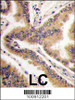 Formalin-fixed and paraffin-embedded human lung carcinoma tissue reacted with P38 delta antibody, which was peroxidase-conjugated to the secondary antibody, followed by DAB staining.