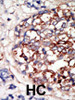 Formalin-fixed and paraffin-embedded human cancer tissue reacted with the primary antibody, which was peroxidase-conjugated to the secondary antibody, followed by DAB staining. BC = breast carcinoma; HC = hepatocarcinoma.