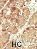 Formalin-fixed and paraffin-embedded human cancer tissue reacted with the primary antibody, which was peroxidase-conjugated to the secondary antibody, followed by DAB staining. BC = breast carcinoma; HC = hepatocarcinoma.