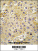 Formalin-fixed and paraffin-embedded human hepatocarcinoma tissue reacted with PPBP antibody, which was peroxidase-conjugated to the secondary antibody, followed by DAB staining.