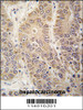 Formalin-fixed and paraffin-embedded human hepatocarcinoma tissue reacted with HARS antibody, which was peroxidase-conjugated to the secondary antibody, followed by DAB staining.