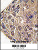Formalin-fixed and paraffin-embedded human lung carcinoma tissue reacted with YARS antibody, which was peroxidase-conjugated to the secondary antibody, followed by DAB staining.