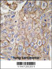 Formalin-fixed and paraffin-embedded human lung carcinoma tissue reacted with CLIC1 antibody, which was peroxidase-conjugated to the secondary antibody, followed by DAB staining.