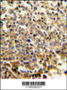 Formalin-fixed and paraffin-embedded human lymphoma reacted with NCF4 Antibody, which was peroxidase-conjugated to the secondary antibody, followed by DAB staining.