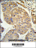 Formalin-fixed and paraffin-embedded human hepatocarcinoma reacted with PHACTR2 Antibody (N-term) , which was peroxidase-conjugated to the secondary antibody, followed by DAB staining.