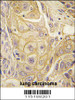 Formalin-fixed and paraffin-embedded human lung carcinoma tissue reacted with EphB2 antibody, which was peroxidase-conjugated to the secondary antibody, followed by DAB staining.