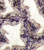 Formalin-fixed and paraffin-embedded prostata carcinoma tissue reacted with LTF Antibody, which was peroxidase-conjugated to the secondary antibody, followed by DAB staining.