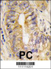 Formalin-fixed and paraffin-embedded human prostata carcinoma tissue reacted with PDGFRA Antibody (Y768) , which was peroxidase-conjugated to the secondary antibody, followed by DAB staining.