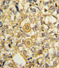 Formalin-fixed and paraffin-embedded human breast carcinoma reacted with PDGFRB Antibody (N-term) , which was peroxidase-conjugated to the secondary antibody, followed by DAB staining.