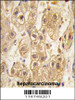 Formalin-fixed and paraffin-embedded human hepatocarcinoma tissue reacted with PDGFRB antibody, which was peroxidase-conjugated to the secondary antibody, followed by DAB staining.