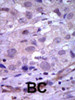 Formalin-fixed and paraffin-embedded human cancer tissue reacted with the primary antibody, which was peroxidase-conjugated to the secondary antibody, followed by AEC staining. BC = breast carcinoma; HC = hepatocarcinoma.