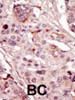 Formalin-fixed and paraffin-embedded human cancer tissue reacted with the primary antibody, which was peroxidase-conjugated to the secondary antibody, followed by AEC staining. BC = breast carcinoma; HC = hepatocarcinoma.