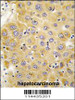 Formalin-fixed and paraffin-embedded human hepatocarcinoma tissue reacted with CTGF antibody, which was peroxidase-conjugated to the secondary antibody, followed by DAB staining.