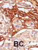 Formalin-fixed and paraffin-embedded human cancer tissue reacted with the primary antibody, which was peroxidase-conjugated to the secondary antibody, followed by AEC staining. BC = breast carcinoma; HC = hepatocarcinoma.