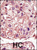 Formalin-fixed and paraffin-embedded human cancer tissue reacted with the primary antibody, which was peroxidase-conjugated to the secondary antibody, followed by AEC staining. BC = breast carcinoma; HC = hepatocarcinoma.