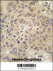 Formalin-fixed and paraffin-embedded human hepatocarcinoma tissue reacted with MARS antibody, which was peroxidase-conjugated to the secondary antibody, followed by DAB staining.