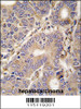 Formalin-fixed and paraffin-embedded human hepatocarcinoma tissue reacted with CARS2 antibody, which was peroxidase-conjugated to the secondary antibody, followed by DAB staining.