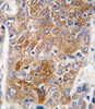 Formalin-fixed and paraffin-embedded human hepatocarcinoma tissue reacted with ALDH1L1 antibody, which was peroxidase-conjugated to the secondary antibody, followed by DAB staining.
