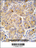 Formalin-fixed and paraffin-embedded human hepatocarcinoma tissue reacted with ALDH9A1 antibody, which was peroxidase-conjugated to the secondary antibody, followed by DAB staining.