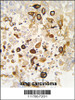 Formalin-fixed and paraffin-embedded human lung carcinoma tissue reacted with CYP4X1 antibody (N-term) , which was peroxidase-conjugated to the secondary antibody, followed by DAB staining.