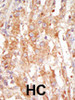 Formalin-fixed and paraffin-embedded human cancer tissue reacted with the primary antibody, which was peroxidase-conjugated to the secondary antibody, followed by DAB staining. BC = breast carcinoma; HC = hepatocarcinoma.