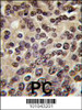Formalin-fixed and paraffin-embedded human prostata carcinoma tissue reacted with PKN beta antibody, which was peroxidase-conjugated to the secondary antibody, followed by DAB staining.