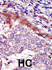 Formalin-fixed and paraffin-embedded human cancer tissue reacted with the primary antibody, which was peroxidase-conjugated to the secondary antibody, followed by AEC staining. BC = breast carcinoma; HC = hepatocarcinoma.