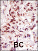 Formalin-fixed and paraffin-embedded human cancer tissue reacted with the primary antibody, which was peroxidase-conjugated to the secondary antibody, followed by DAB staining. BC = breast carcinoma; HC = hepatocarcinoma.