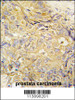 Formalin-fixed and paraffin-embedded human prostata carcinoma tissue reacted with FGF10 antibody, which was peroxidase-conjugated to the secondary antibody, followed by DAB staining.