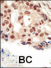 Formalin-fixed and paraffin-embedded human cancer tissue reacted with the primary antibody, which was peroxidase-conjugated to the secondary antibody, followed by AEC staining. BC = breast carcinoma; HC = hepatocarcinoma.