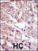 Formalin-fixed and paraffin-embedded human cancer tissue reacted with the primary antibody, which was peroxidase-conjugated to the secondary antibody, followed by AEC staining. BC = breast carcinoma; HC = hepatocarcinoma.