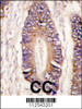 Formalin-fixed and paraffin-embedded human colon carcinoma tissue reacted with MLK4 antibody, which was peroxidase-conjugated to the secondary antibody, followed by DAB staining.