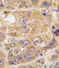 Formalin-fixed and paraffin-embedded human hepatocarcinoma tissue reacted with LDLRAP1 antibody, which was peroxidase-conjugated to the secondary antibody, followed by DAB staining.