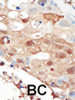 Formalin-fixed and paraffin-embedded human cancer tissue reacted with the primary antibody, which was peroxidase-conjugated to the secondary antibody, followed by AEC staining. BC = breast carcinoma; HC = hepatocarcinoma.