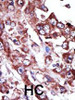 Formalin-fixed and paraffin-embedded human cancer tissue reacted with the primary antibody, which was peroxidase-conjugated to the secondary antibody, followed by AEC staining. BC = breast carcinoma; HC = hepatocarcinoma.