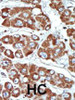 Formalin-fixed and paraffin-embedded human cancer tissue reacted with the primary antibody, which was peroxidase-conjugated to the secondary antibody, followed by DAB staining. BC = breast carcinoma; HC = hepatocarcinoma.